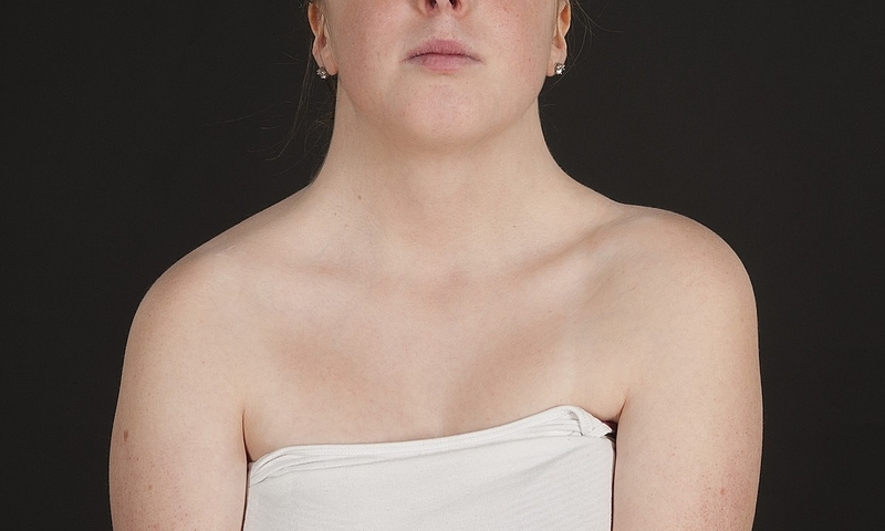 Hội chứng Turner: Nguyên nhân, biểu hiện, điều trị ra sao? 2