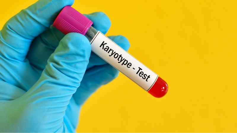 Xét nghiệm Karyotype hỗ trợ chẩn đoán hội chứng Turner
