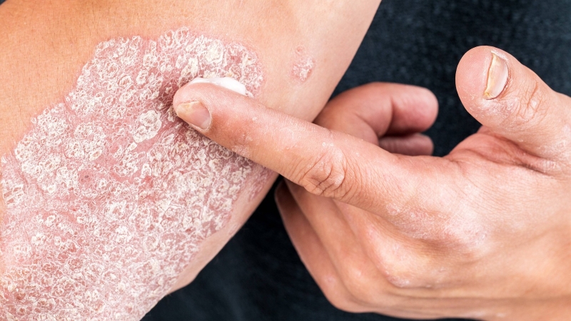 Hội chứng viêm ở bệnh vẩy nến: Mối nguy hiểm khó lường 2