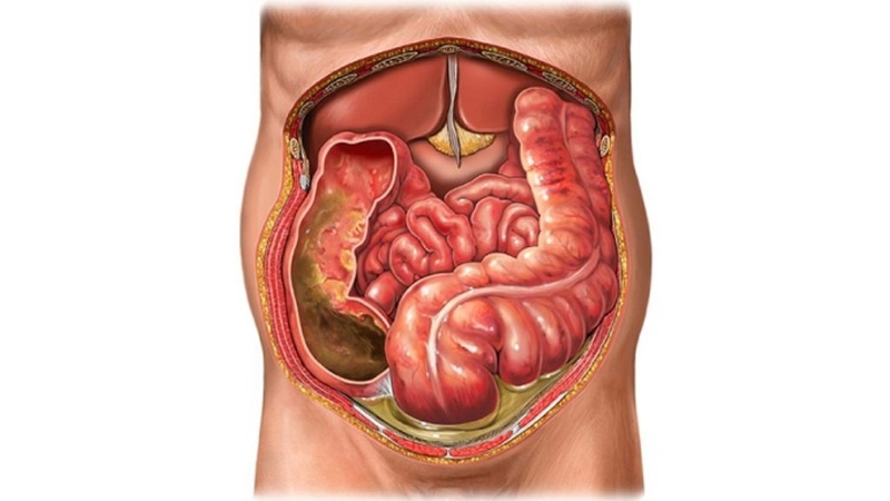 Hội chứng viêm phúc mạc và những điều bạn nên biết 1