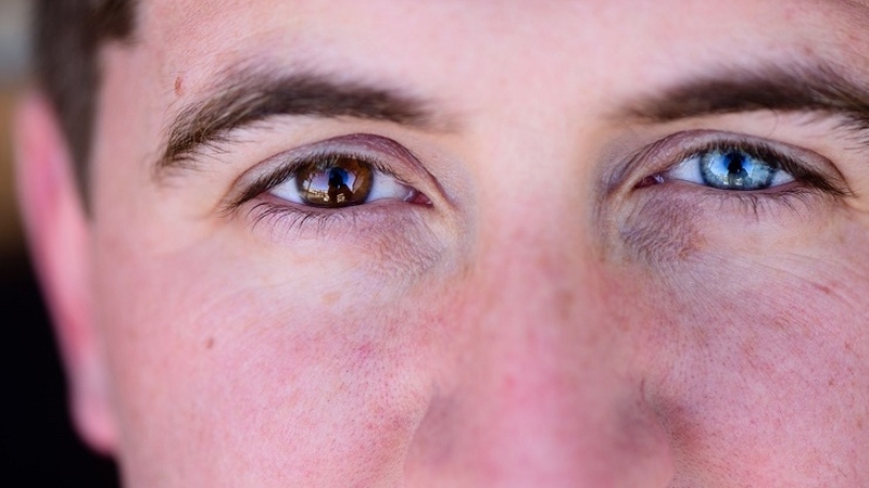 Hội chứng Waardenburg là gì? Nguyên nhân và cách điều trị hội chứng Waardenburg 1