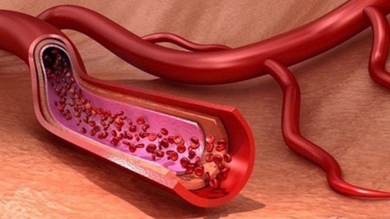 Hội chứng xuất huyết: Nguyên nhân, triệu chứng, chẩn đoán và phương pháp điều trị 1