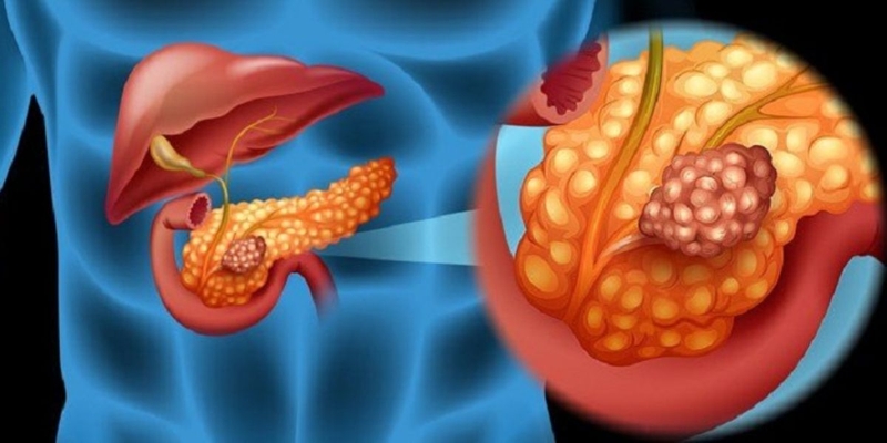 Hội chứng Zollinger-Ellison là gì? Bạn cần biết gì về tình trạng này? 1