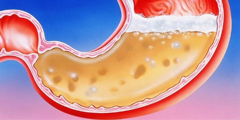 Hội chứng Zollinger-Ellison là gì? Bạn cần biết gì về tình trạng này? 2