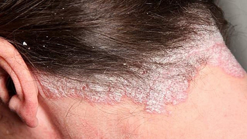 Hỏi đáp: Bệnh vảy nến da đầu có lây không? Chữa bằng cách nào? 1