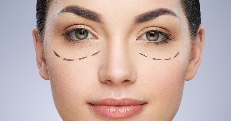 Hỏi đáp làm đẹp: Cắt mí bao lâu thì hết sẹo?1