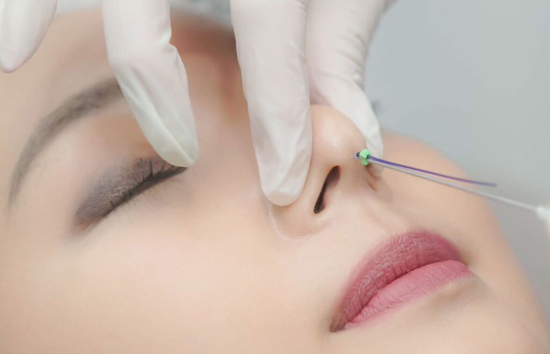 Hỏi đáp: Nâng mũi chỉ có an toàn không? 3