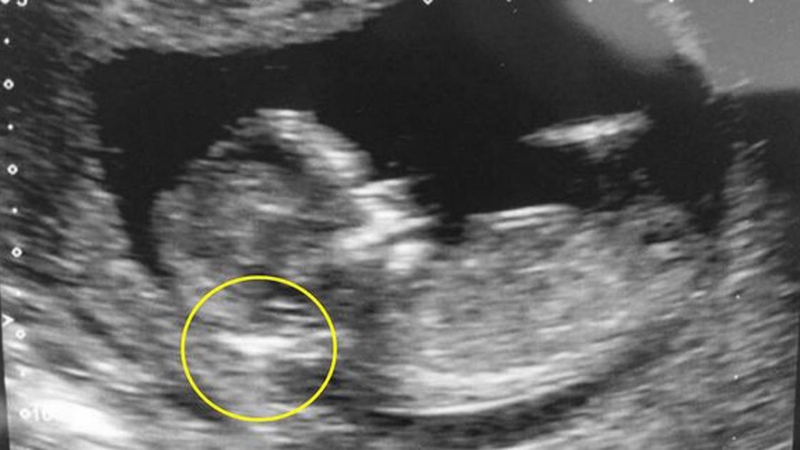 [Hỏi đáp] Siêu âm 4D có phát hiện bệnh Down không 1