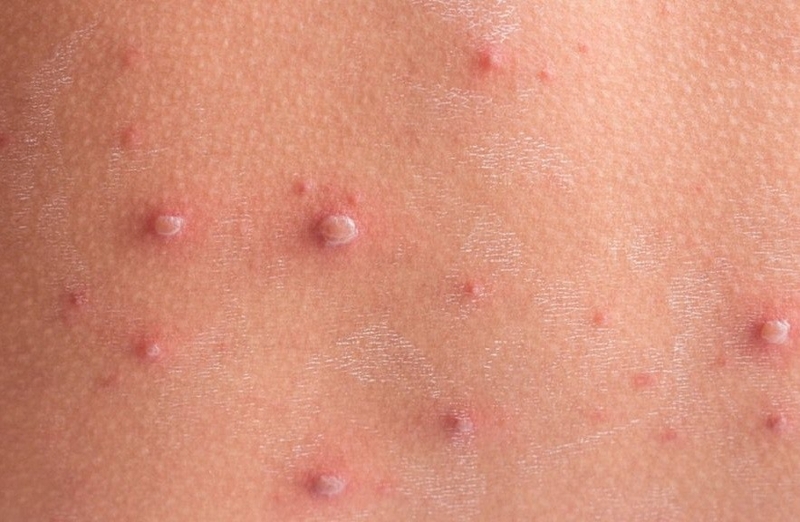 Hỏi và đáp: Bị thuỷ đậu có quan hệ được không? 1