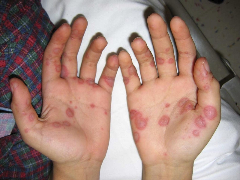 Hồng ban đa dạng là bệnh gì? Nguyên nhân, triệu chứng và cách điều trị hồng ban đa dạng 2