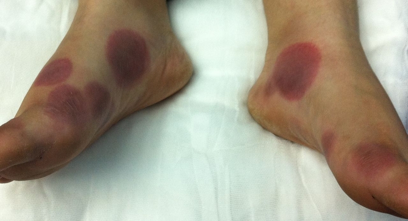 Hồng ban sắc tố cố định là gì? 1