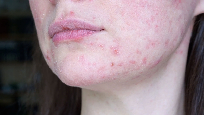 Hồng ban sau viêm: Nguyên nhân và cách điều trị hiệu quả 1