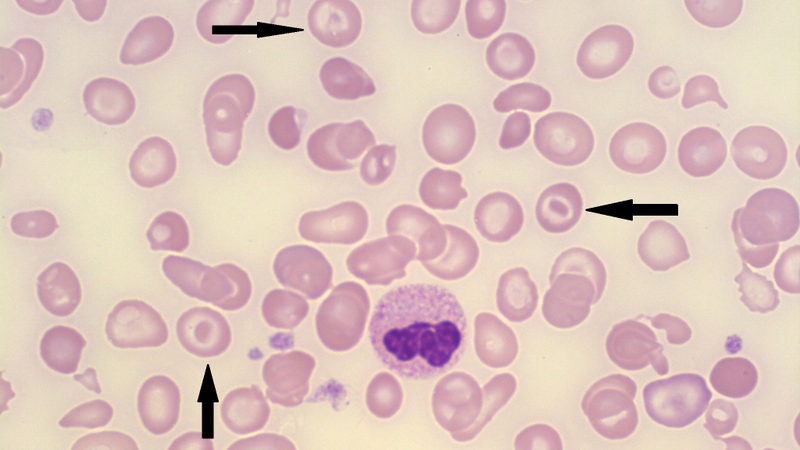 “Hồng cầu hình bia là gì?” chắc hẳn là câu hỏi mà nhiều người thắc mắc khi đi xét nghiệm máu