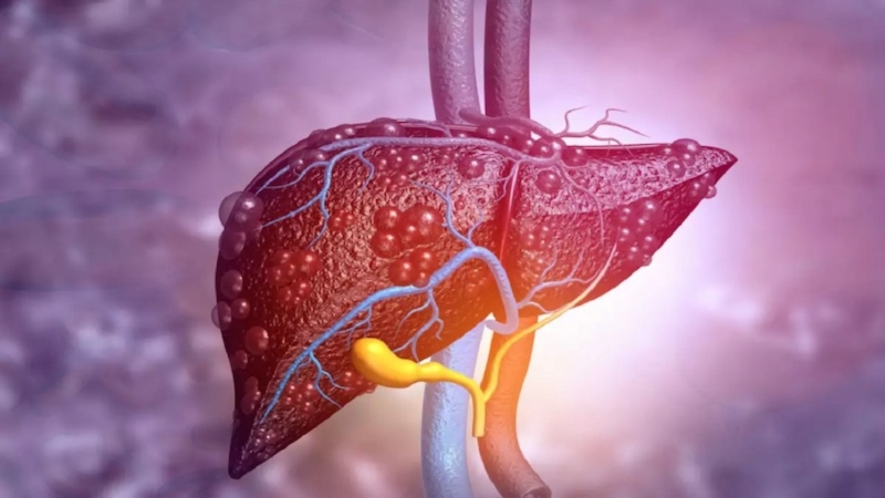 Rối loạn chức năng gan có thể liên quan đến sự xuất hiện của hồng cầu dạng hình bia