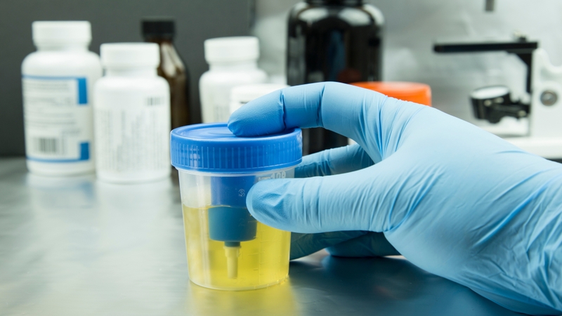 Hồng cầu trong nước tiểu bao nhiêu là bình thường? Nguyên nhân phổ biến gây hồng cầu trong nước tiểu 3