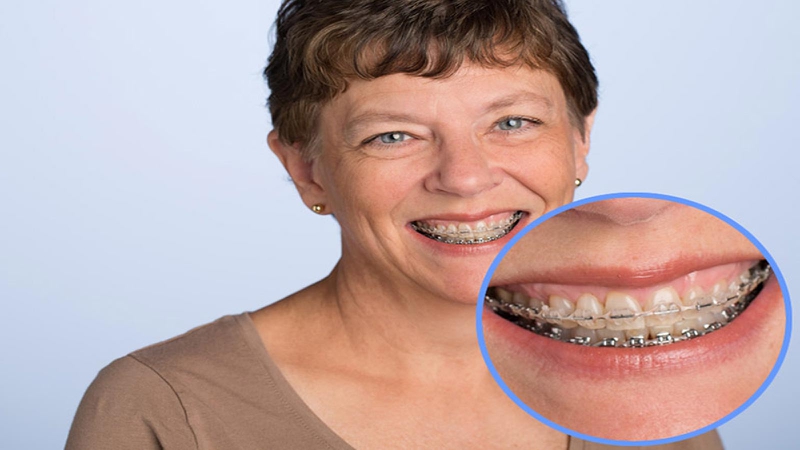 50 tuổi có nên niềng răng không? Cần lưu ý gì? 1