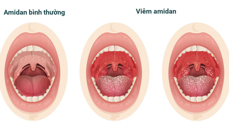 Hôi Miệng Từ Cổ Họng: Nguyên Nhân, Giải Pháp Và Cách Điều Trị Hiệu Quả