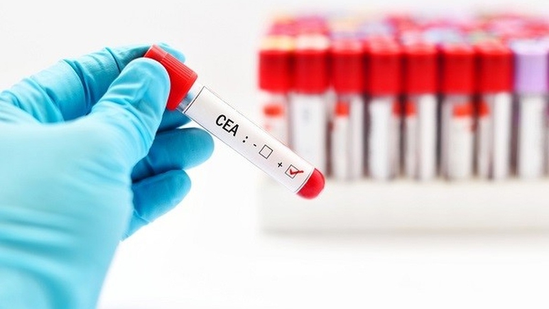 Xét nghiệm CEA - Phương pháp chẩn đoán các bệnh ung thư +1