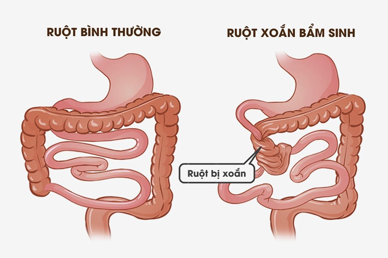 Xoắn ruột: Một tình trạng cấp cứu khẩn cấp 1