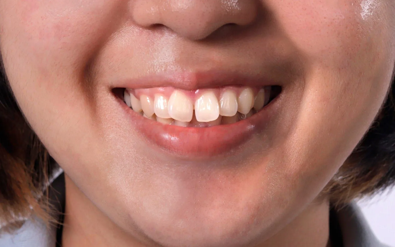 6 thói quen làm răng hô ở trẻ em khiến bố mẹ bất ngờ 1