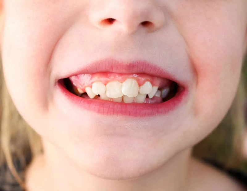 6 thói quen làm răng hô ở trẻ em khiến bố mẹ bất ngờ 4