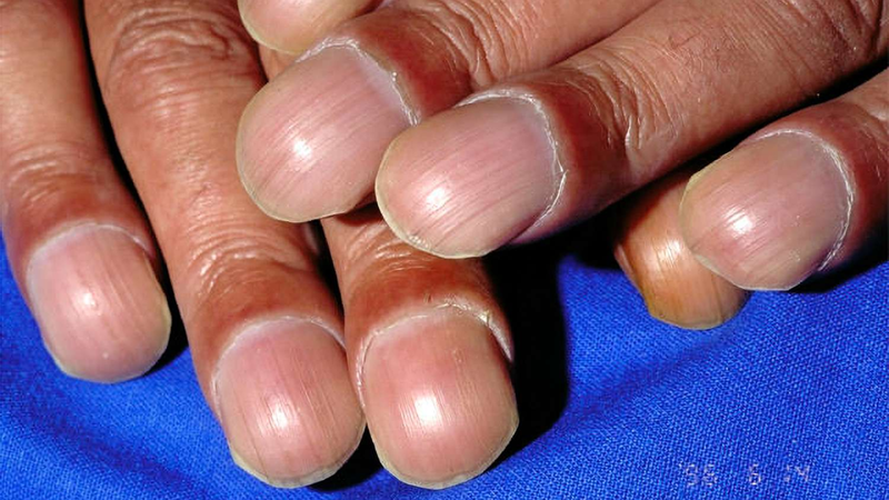 Móng tay dùi trống là dấu hiếu bất thường có thể liên quan đến sức khỏe