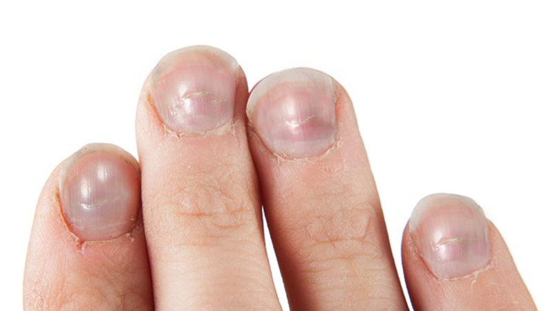 Bề mặt móng đôi khi xuất hiện các rãnh ngang