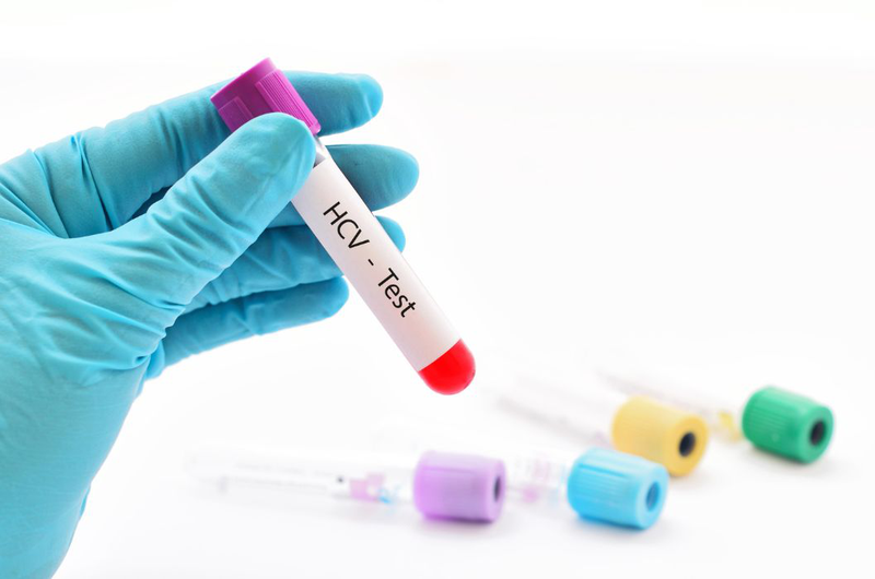 Xét nghiệm Anti HCV nonreactive trong chẩn đoán viêm gan C 2