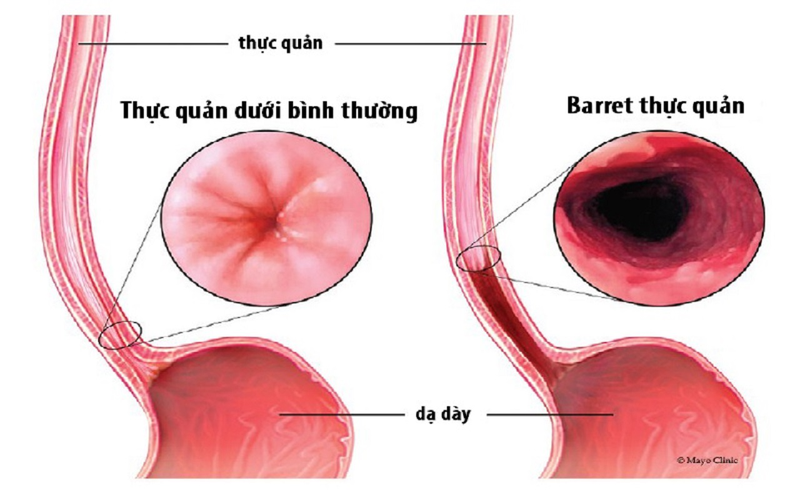 Thắc mắc: Trào ngược dạ dày ăn bơ được không? 6