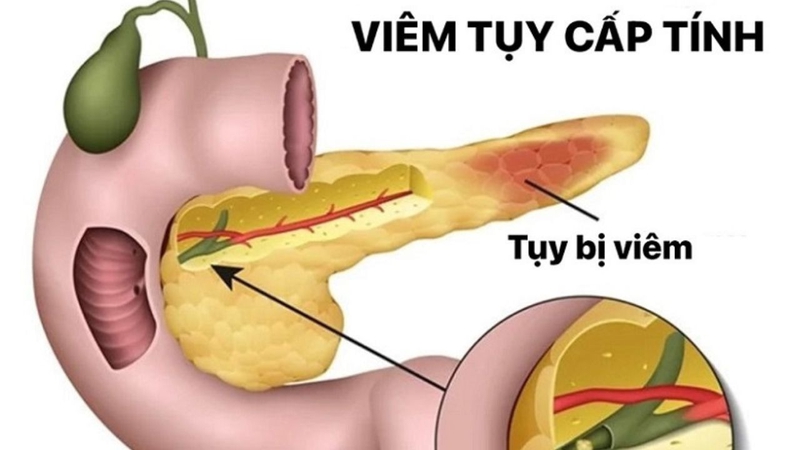 Những biến chứng đặc biệt nguy hiểm của viêm tụy cấp mà bạn cần biết 1