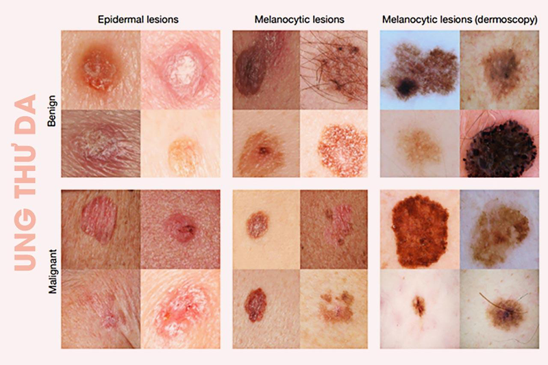 Một số nhỏ các nốt ruồi loạn sản có thể phát triển thành khối u ác tính gây ung thư da