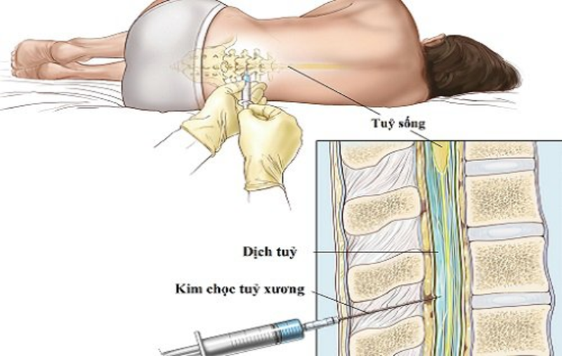 Chọc dò tủy sống là gì? 2.png