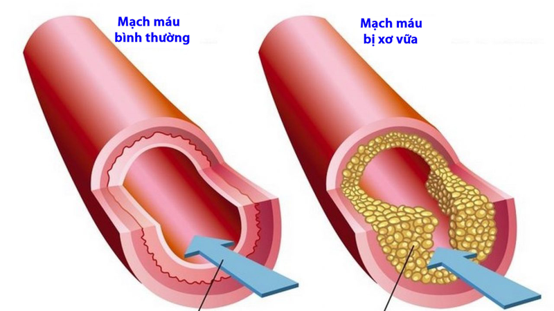 DIA là chỉ số có ý nghĩa gì trên máy đo huyết áp? 2
