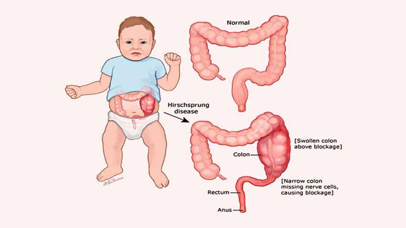 Tìm hiểu về hội chứng Mowat-Wilson 1