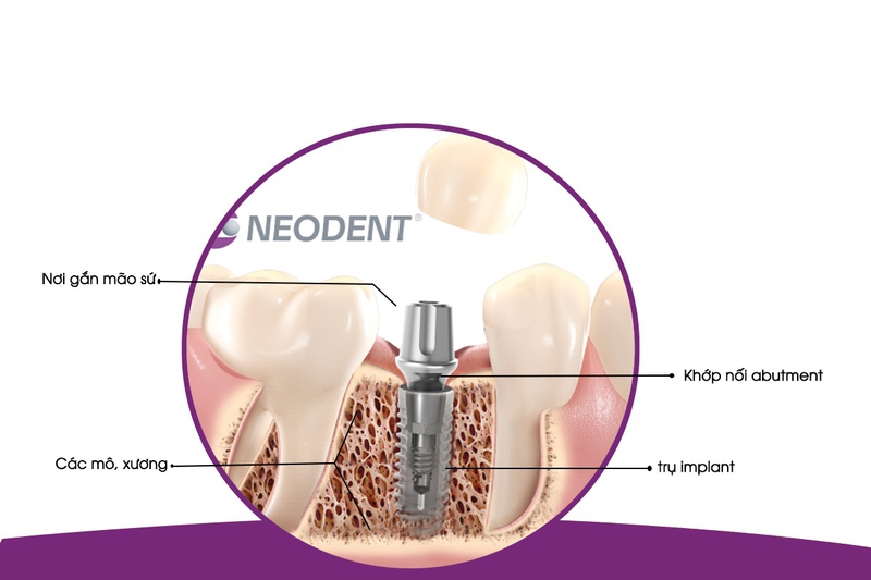 Tìm hiểu về đặc điểm và lợi ích khi cấy Implant Neodent 3