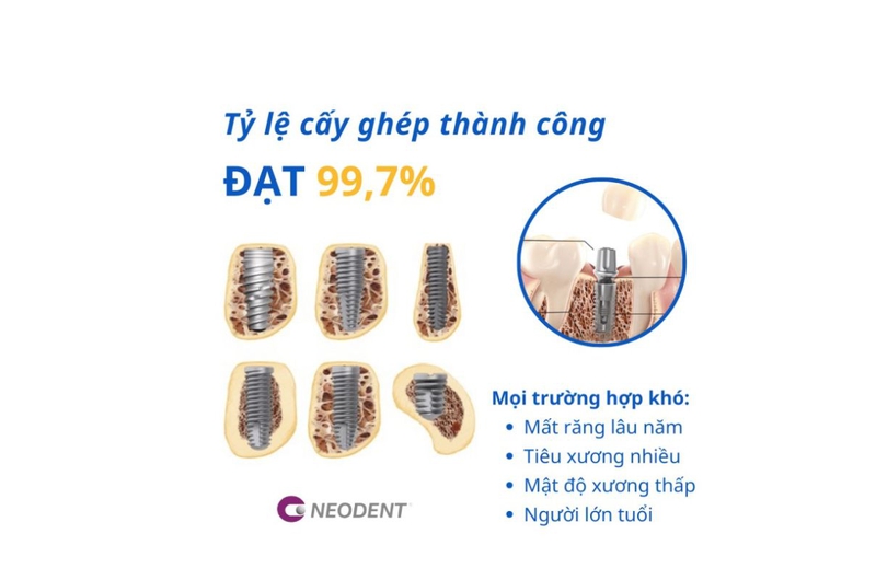 Tìm hiểu về đặc điểm và lợi ích khi cấy Implant Neodent 4