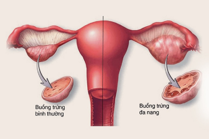 Kích thước buồng trứng gây ảnh hưởng gì tới vấn đề mang thai? 3