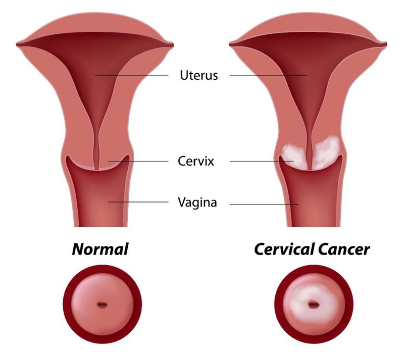 Nguyên nhân ung thư cổ tử cung, chẩn đoán và cách phòng tránh bệnh hiệu quả 1