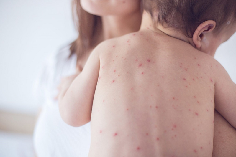 Nhận biết hình ảnh bệnh sốt xuất huyết ở trẻ em