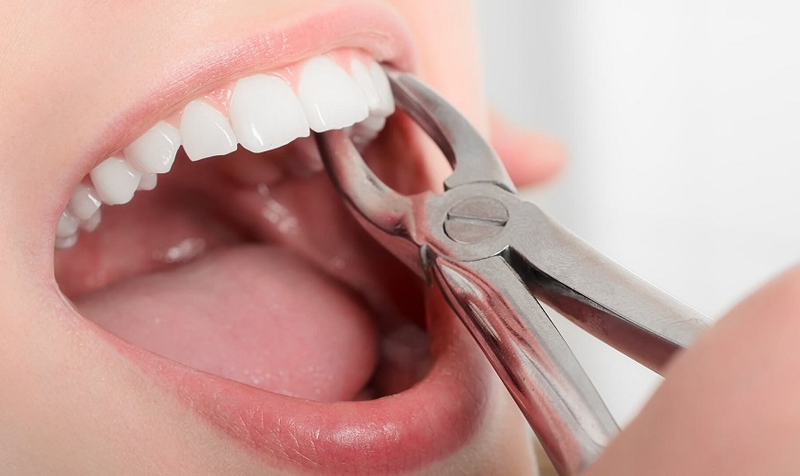 Nhổ răng số 4 để niềng răng có tốt không? Nên làm thế nào? 2