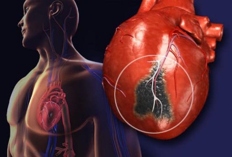 Nhồi máu cơ tim là bệnh gì? Nhồi máu cơ tim có tái phát không? 1