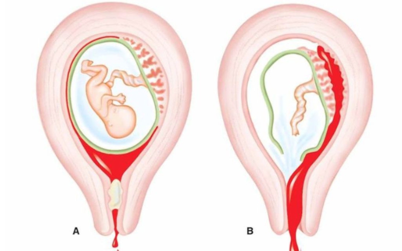 Nội xoay thai là gì? Quy trình kỹ thuật thực hiện nội xoay thai 1