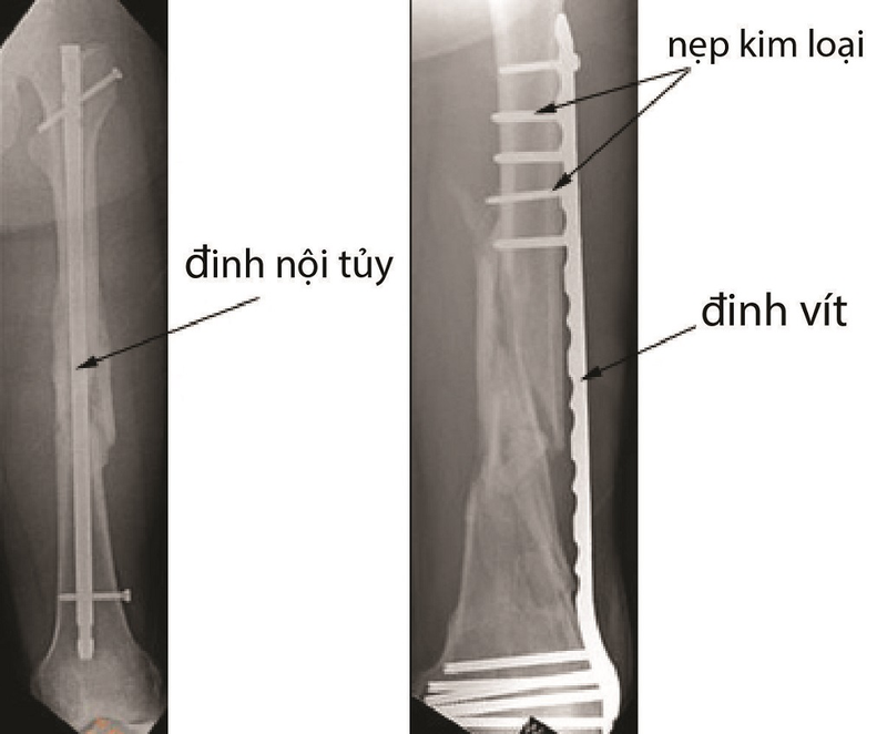 Phẫu thuật kết hợp xương là gì? 3