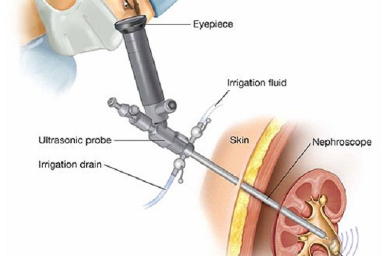 Phương pháp tán sỏi thận bằng công nghệ hiện đại