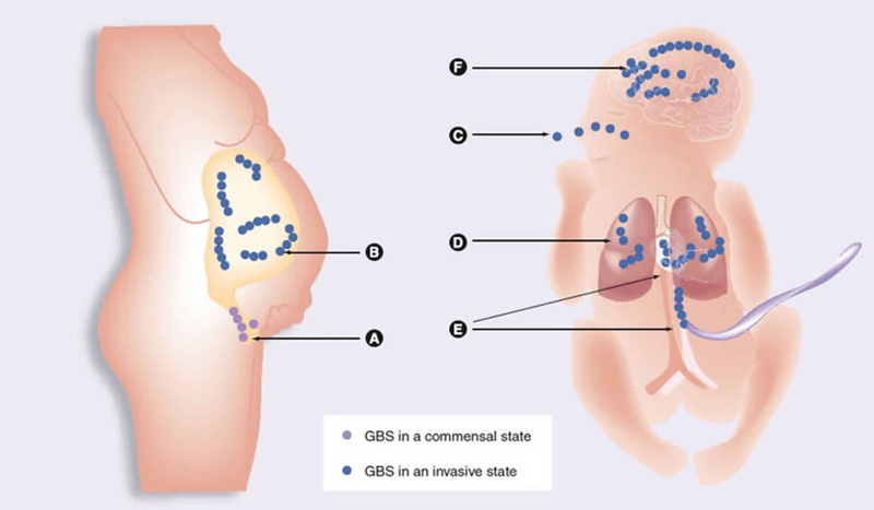 Streptococcus agalactiae có thể lây nhiễm cho trẻ sơ sinh trong quá trình mang thai