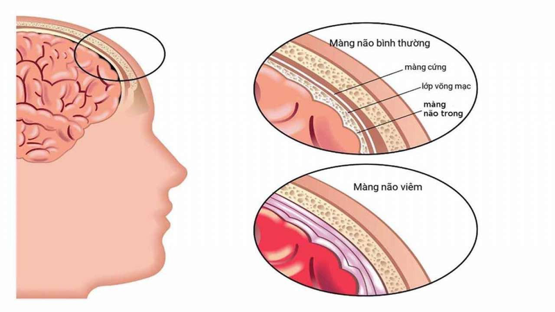 Streptococcus pneumoniae gây ra những bệnh gì? 3