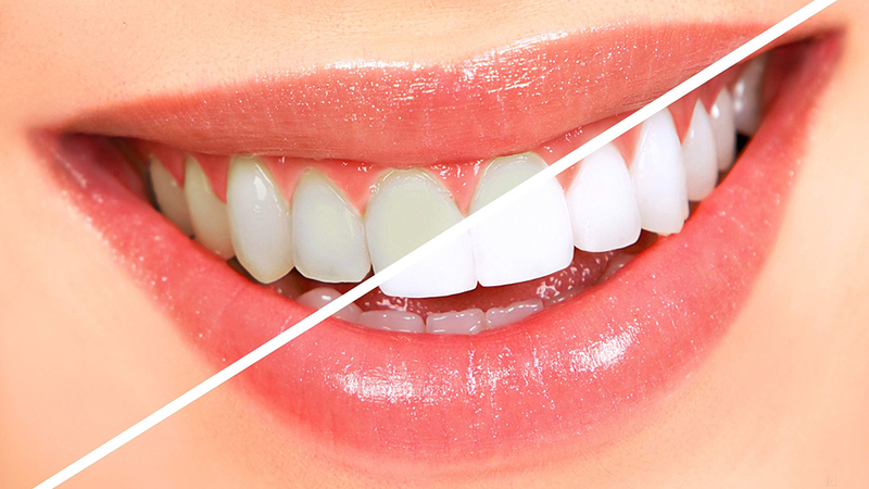 Tẩy trắng răng có hại không? Khi nào cần tẩy trắng răng 2