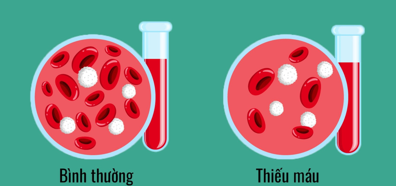 Thể tích trung bình hồng cầu 03