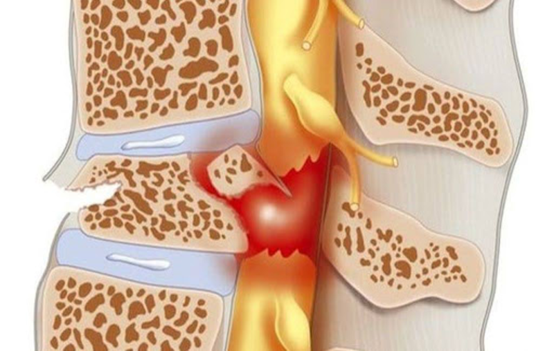 Tuỷ sống và những điều cần biết 4.png