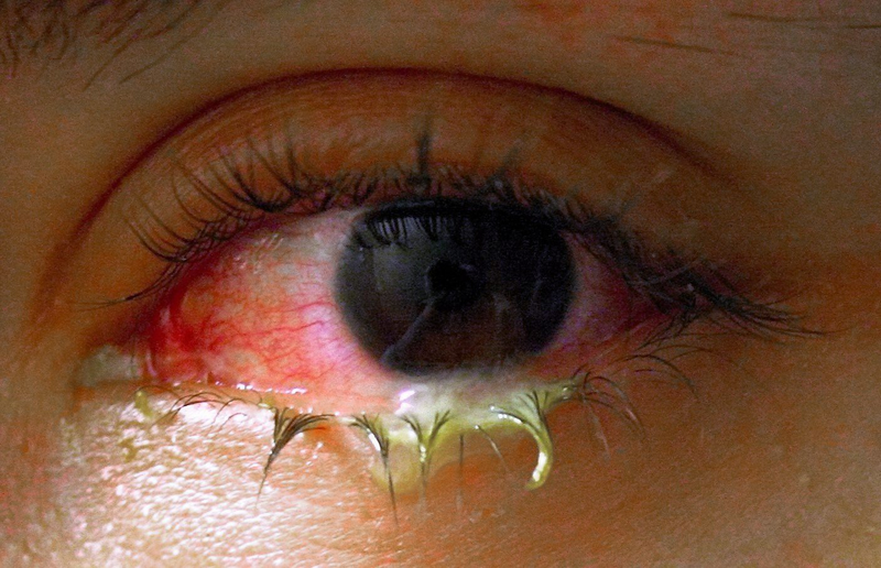 Viêm kết mạc mắt là gì? Nguyên nhân, triệu chứng, cách điều trị và phòng ngừa viêm kết mạc mắt 4